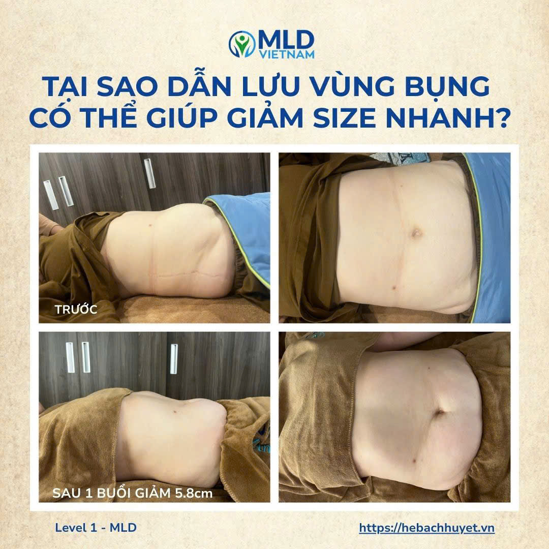 Dẫn lưu vùng bụng: vì sao lại giảm size nhanh đến vậy?