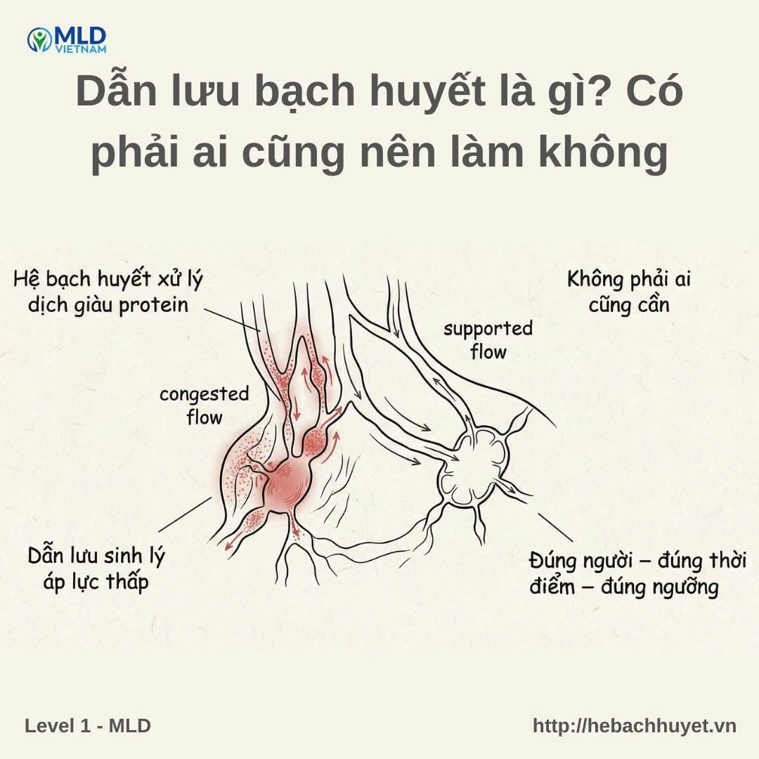 Dẫn lưu bạch huyết là gì? Có phải ai cũng nên làm không?