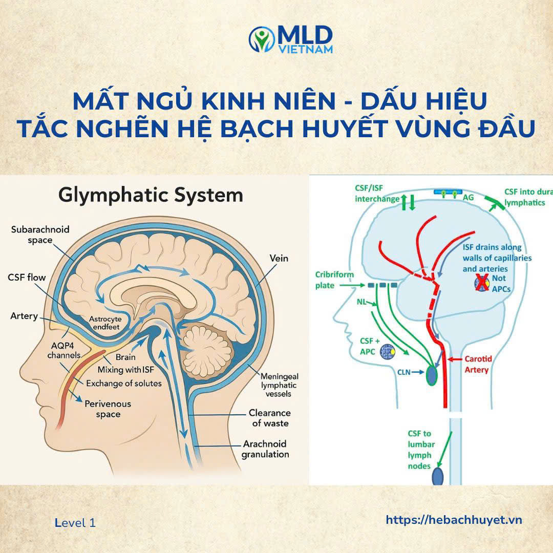 “Người mất ngủ kinh niên — có thể do dòng bạch huyết não bị tắc!”