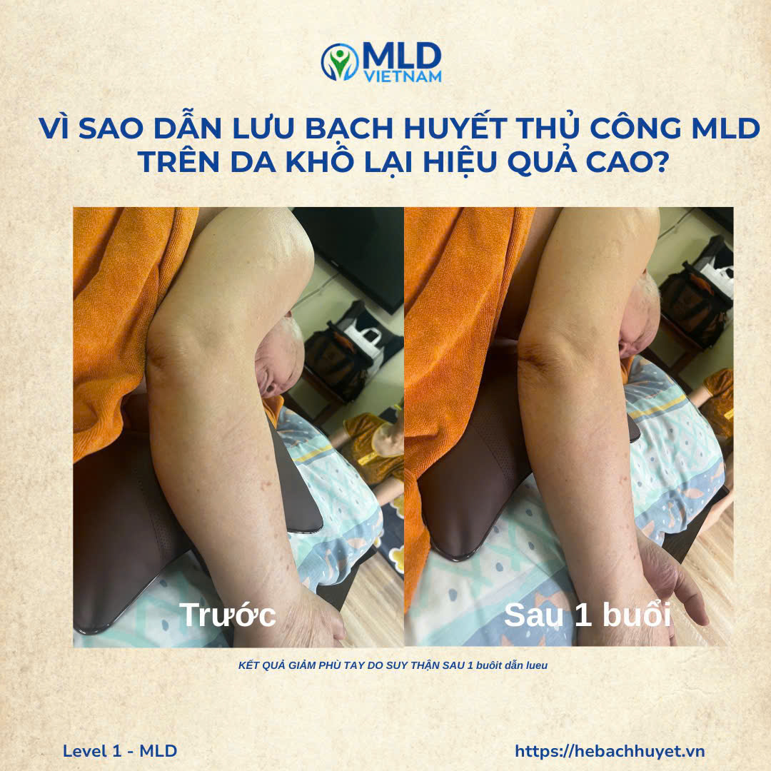 💧 Vì sao dẫn lưu bạch huyết trên da khô (không dùng dầu) lại hiệu quả cao trong giảm phù?