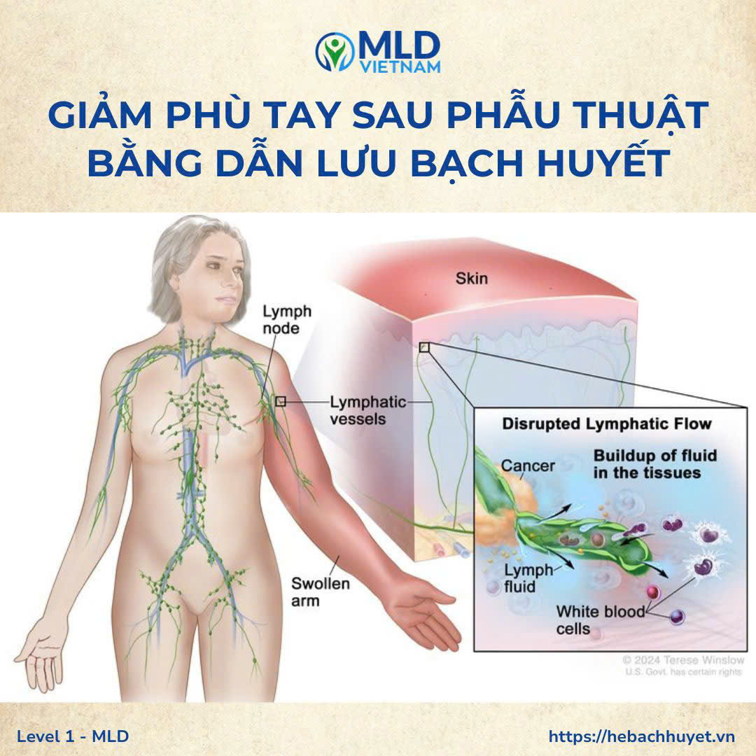 Phù tay sau phẫu thuật ung thư vú: không phải biến chứng hiếm gặp, mà là điều cần được chăm sóc đúng cách