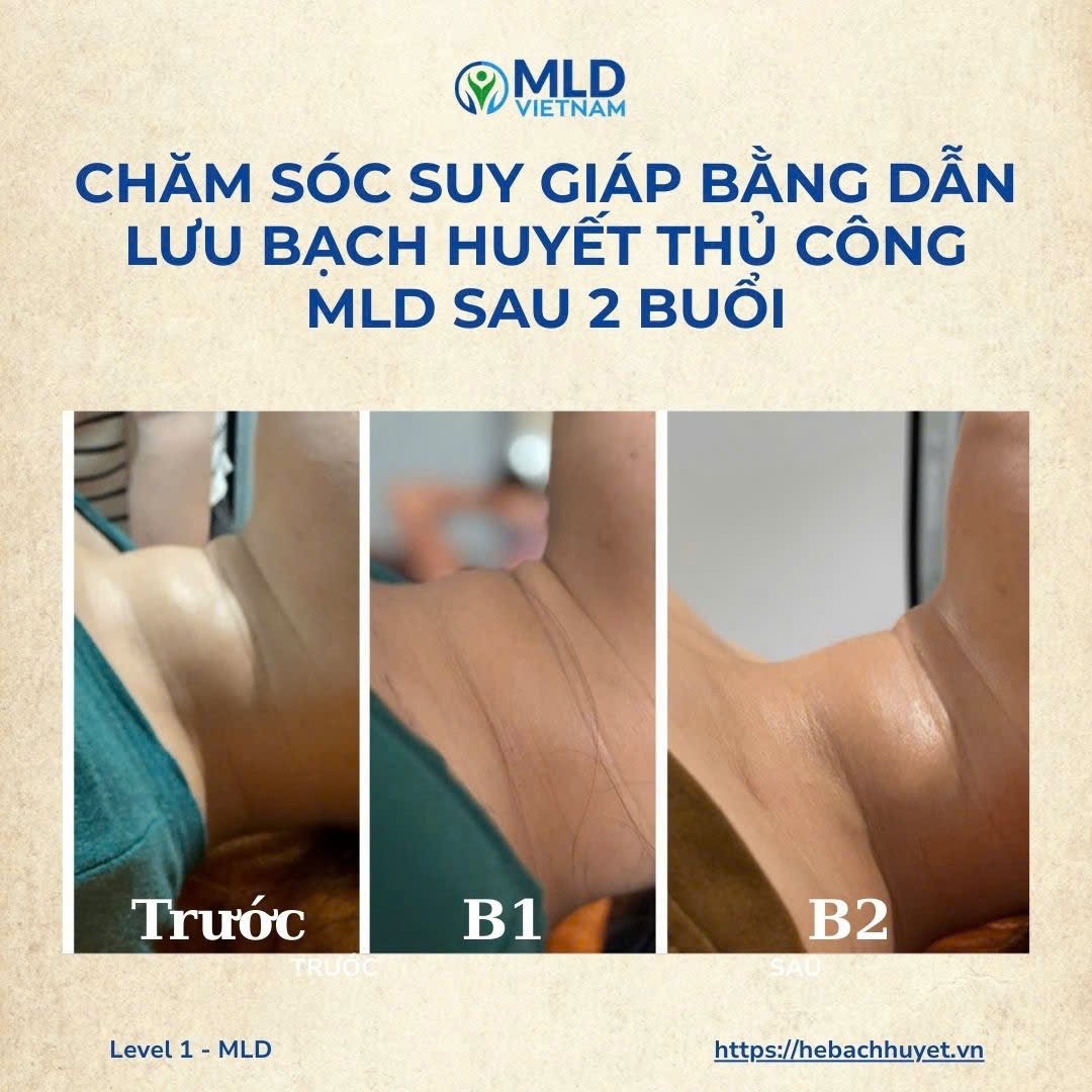 Dẫn lưu bạch huyết & suy giáp: vì sao có thể giúp giảm bướu cổ?
