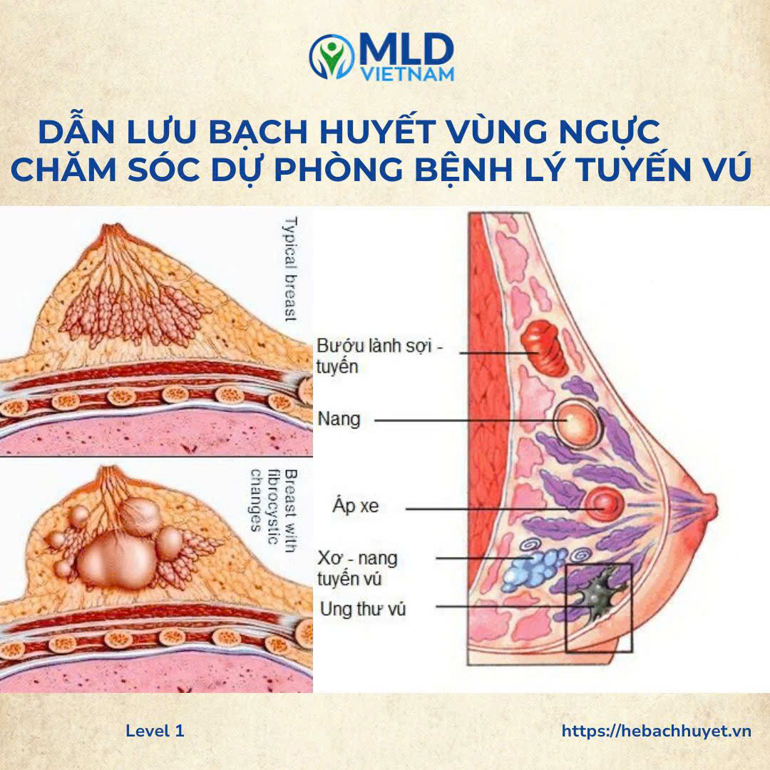Chăm sóc & dự phòng các bệnh lý tuyến vú bằng dẫn lưu bạch huyết