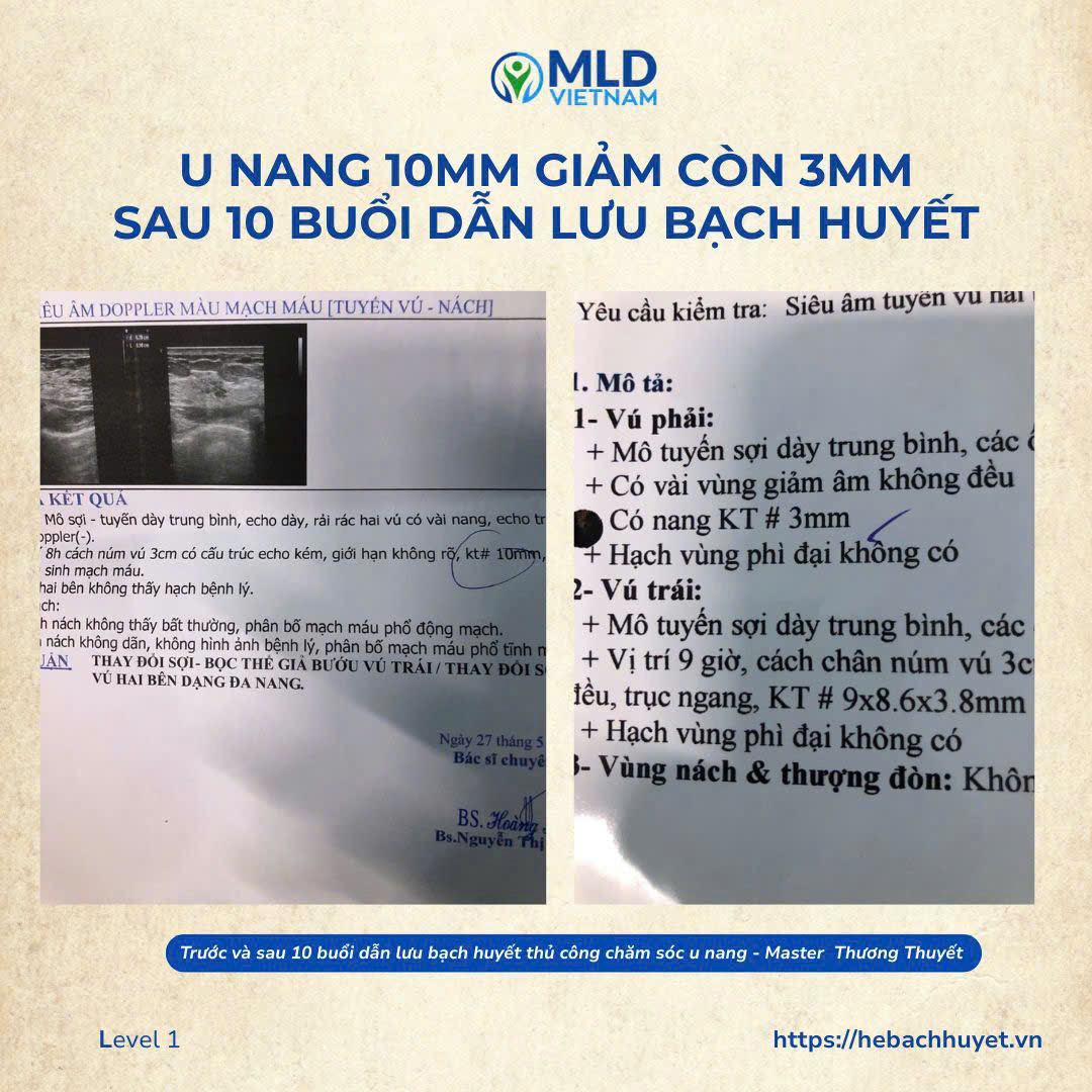Tác dụng hỗ trợ của MLD đối với vùng có u nang